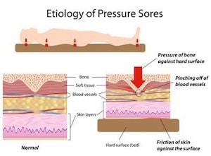 bedsores tissue damage and other health conditions