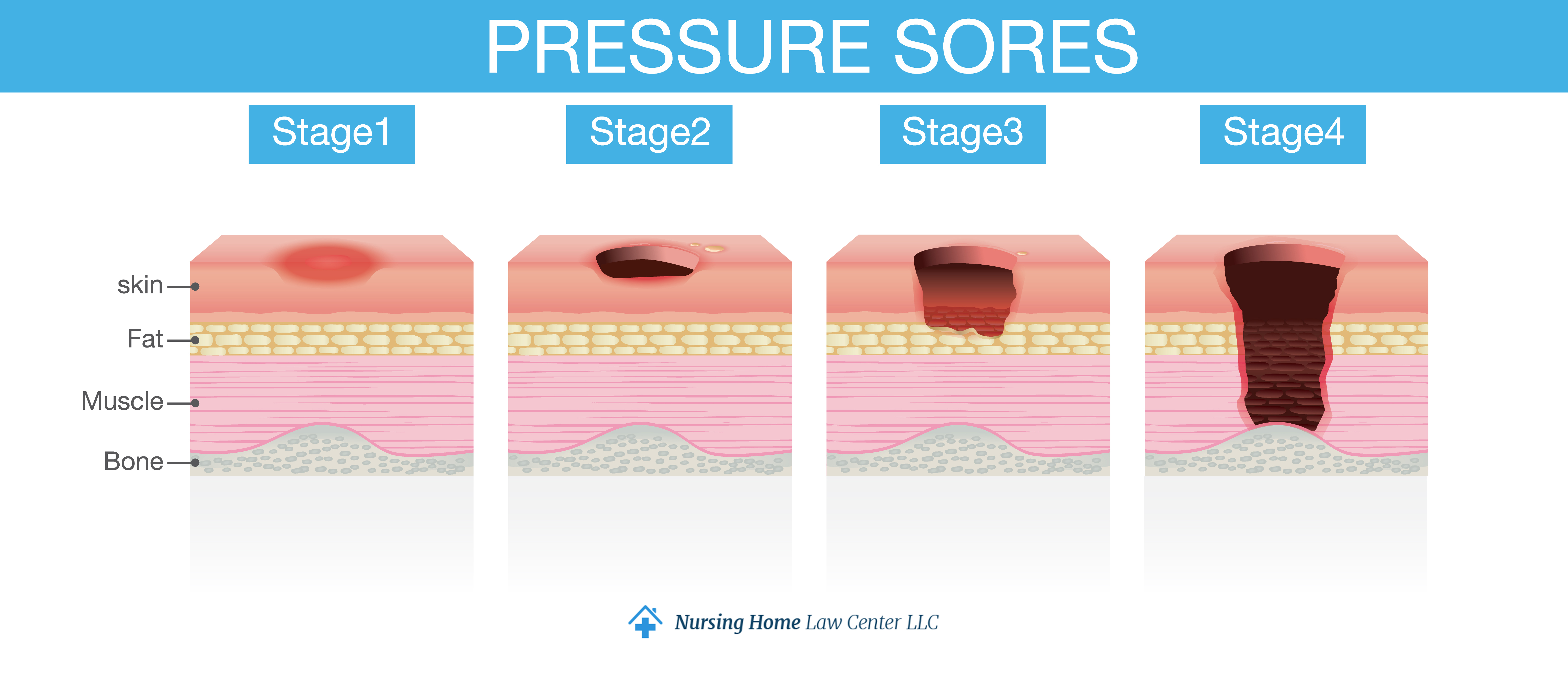 Stages of Pressure Sores