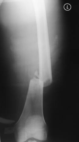 fractured femur.jpg