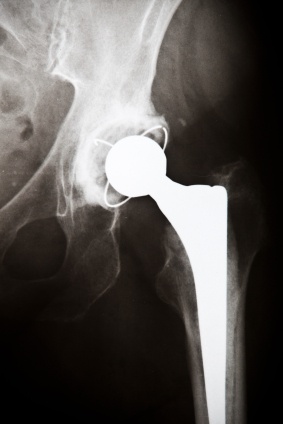 metal artifical hip