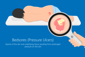 stage-2-pressure-ulcer-nursing-home-resident