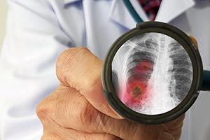 nursing-home-respiratory-infection-lawsuit