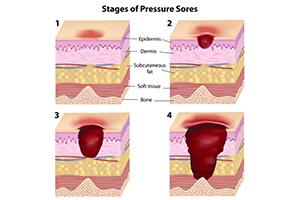 stage-three-bed-sore-nursing-home-resident