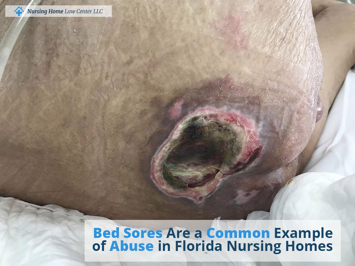 florida bed sore injury lawyer