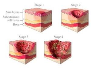 Wound Bedsores