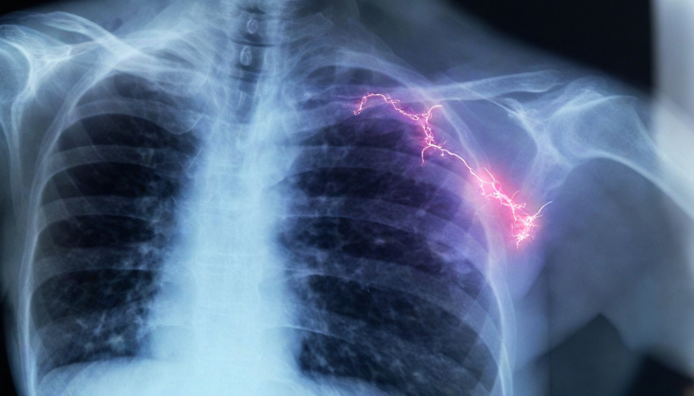 Nursing home abuse attorney addressing the risks of aspiration pneumonia in nursing home residents, advocating for justice when negligence leads to severe health complications.