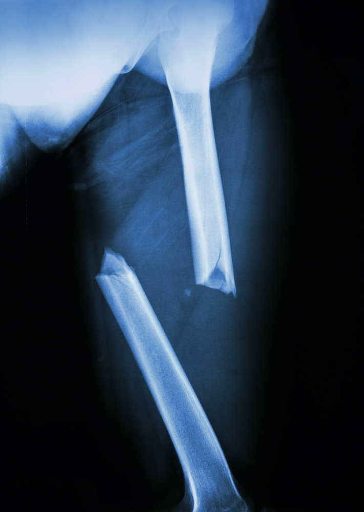 A nursing home abuse lawyer can help families of residents who suffer from broken femurs due to neglect, inadequate supervision, or environmental hazards, ensuring fair compensation for medical bills and pain.