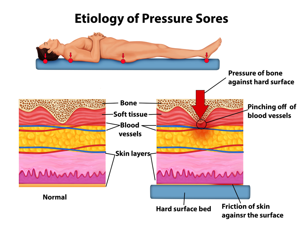 Bed sore causes include restricted blood flow and immobility in elderly patients
