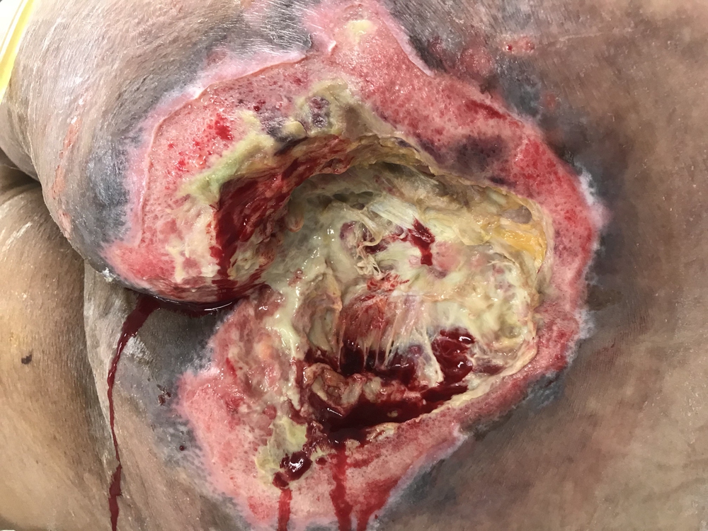 Bed sores developing in nursing home residents due to prolonged neglect
