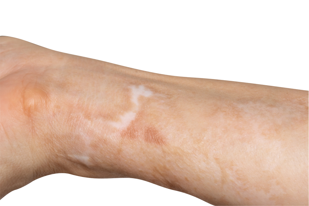 Lawyer representing nursing home residents suffering from burn injuries