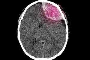 Elderly nursing home resident with head trauma leading to subdural hematoma
