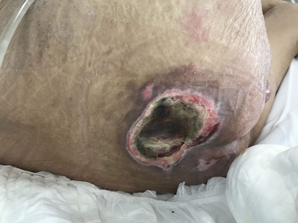 Legal case involving nursing home abuse and preventable bed sores 
