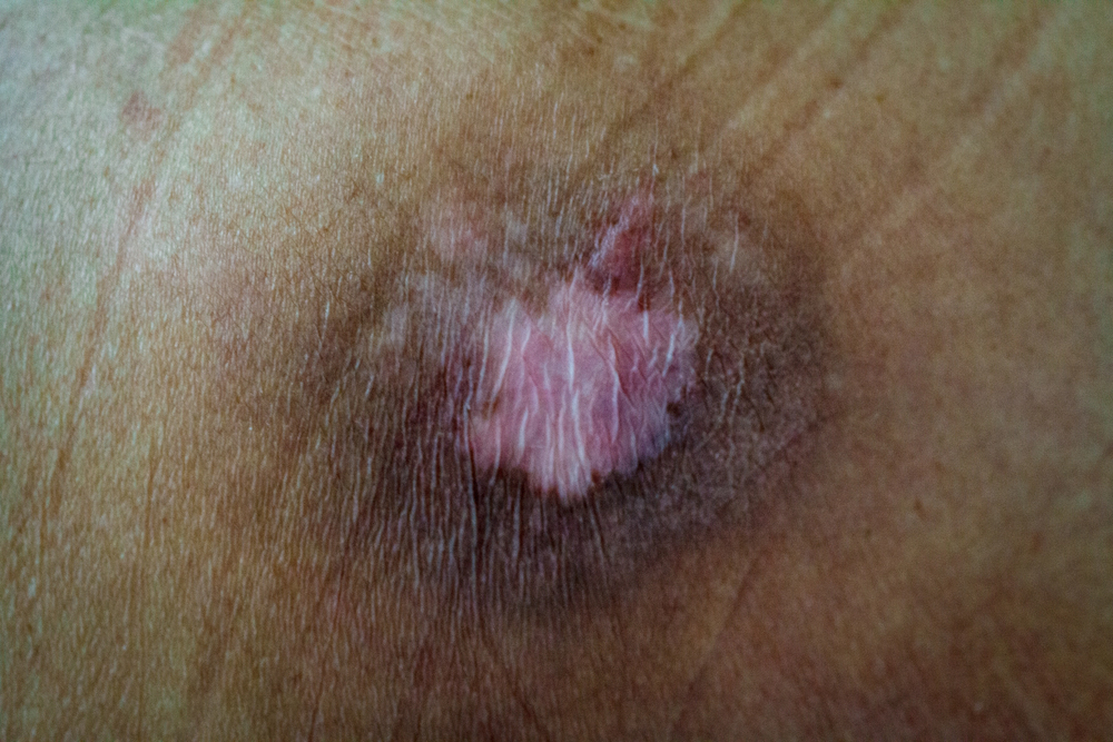 Pressure ulcer settlements involving nursing homes and elder care facilities
