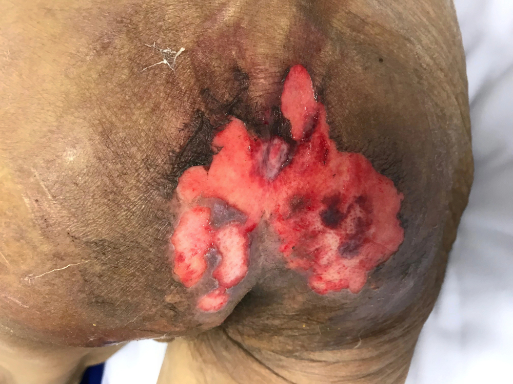 Pressure injuries linked to nursing home abuse and lack of care
