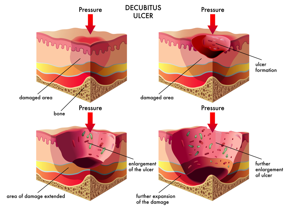 Pressure sores caused by prolonged pressure on skin and underlying tissue
