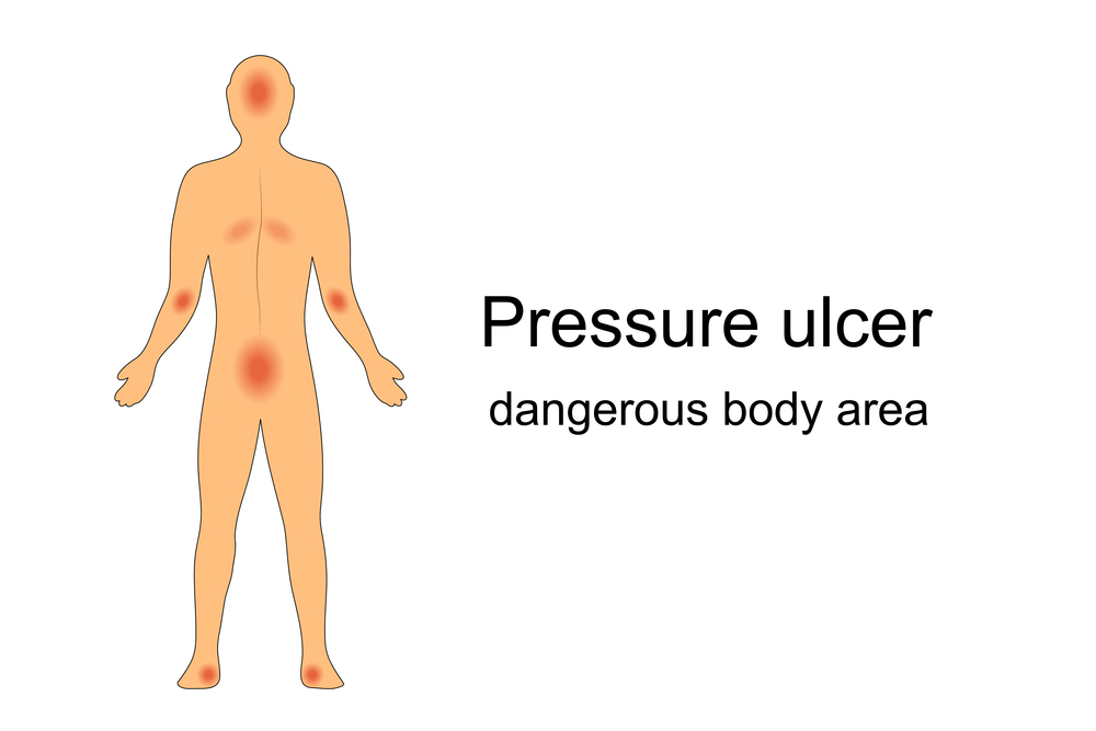 Pressure ulcers developing in nursing home residents due to lack of repositioning
