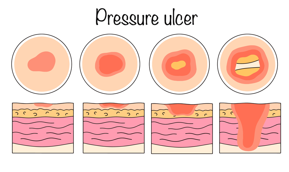 Pressure ulcer settlements involving nursing homes and elder care facilities

