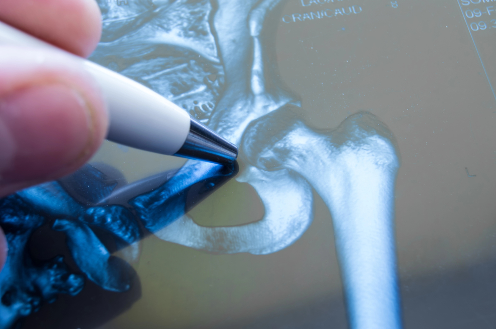 Experienced attorney handling nursing home hip fracture cases in Chicago.