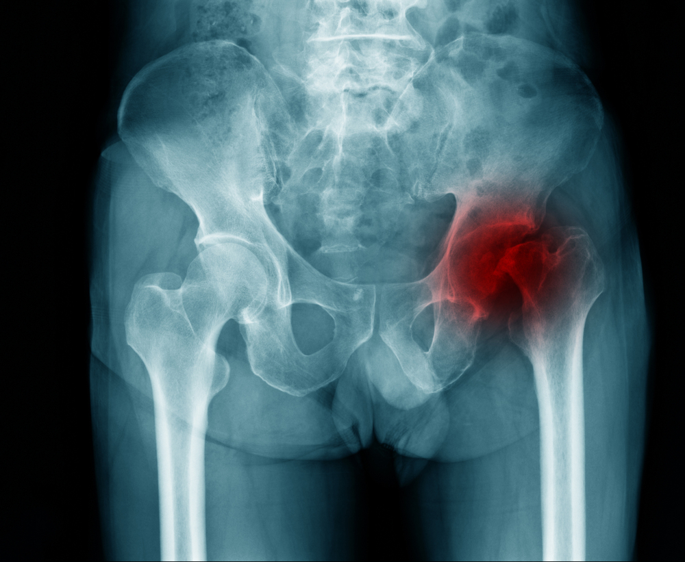 Law firm specializing in nursing home hip fracture cases and abuse claims.