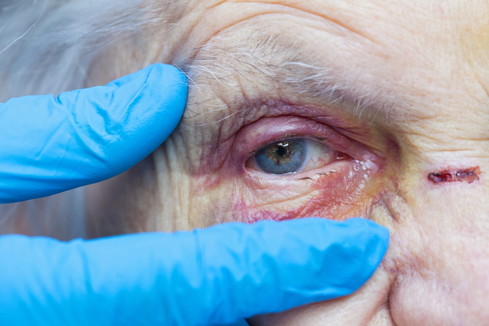 Evidence of physical abuse injuries in a Chicago nursing home resident 