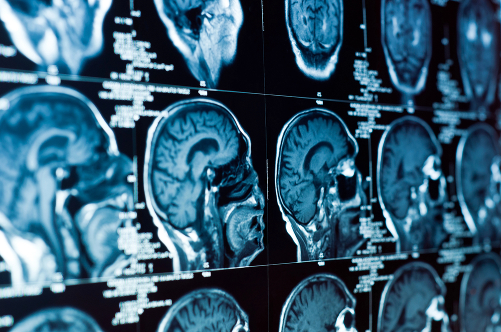 Experienced attorney handling nursing home subdural hematoma injury claims.