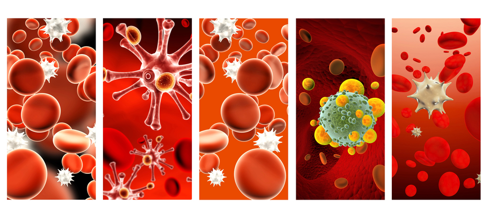 Medical illustration showing the three stages of sepsis progression
