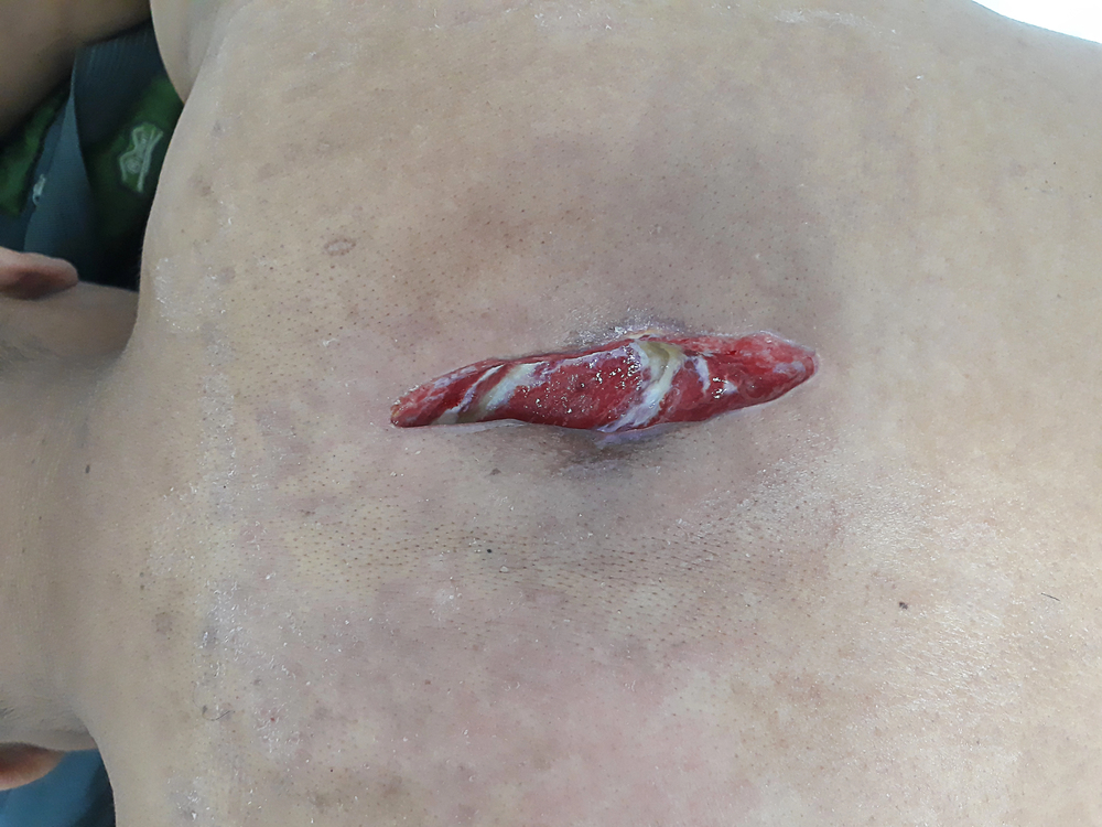 Early symptoms of bed sores on a nursing home resident’s back