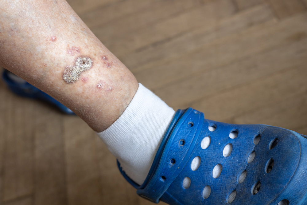 Nursing home resident with visible pressure sores being evaluated for legal action
