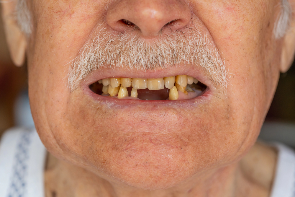 Lawyer helping families address the risks of poor oral healthcare in nursing home residents.