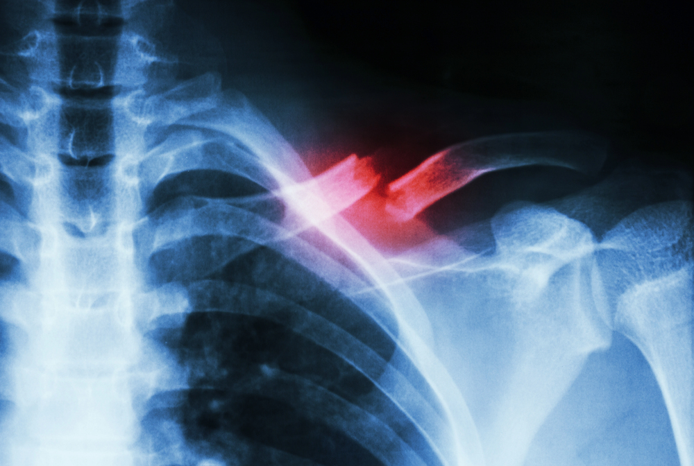 Elderly residents suffering bone fractures from nursing home neglect