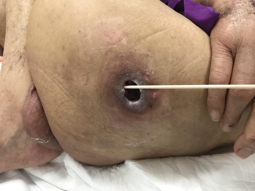 Hospitals failing to provide proper care for advanced bedsores