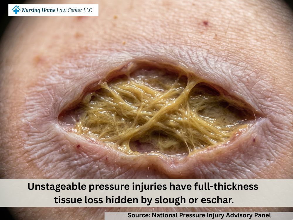 Unstageable bed sore with slough or eschar covering the wound bed and obscuring depth