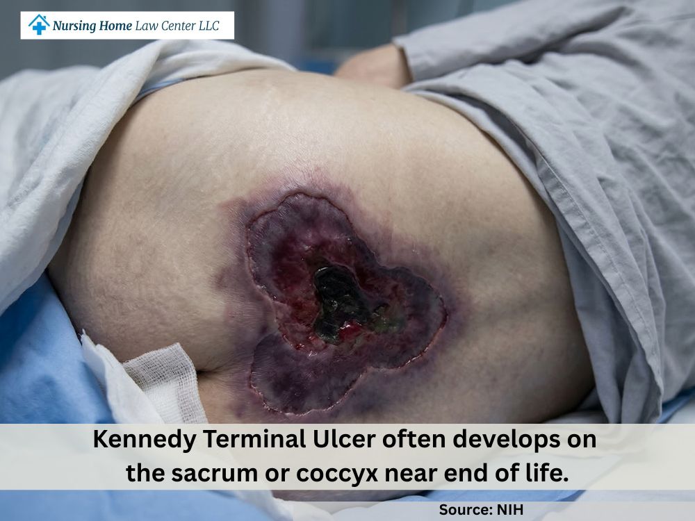 Kennedy terminal ulcer on the sacrum with irregular pear or butterfly-shaped skin breakdown near end of life