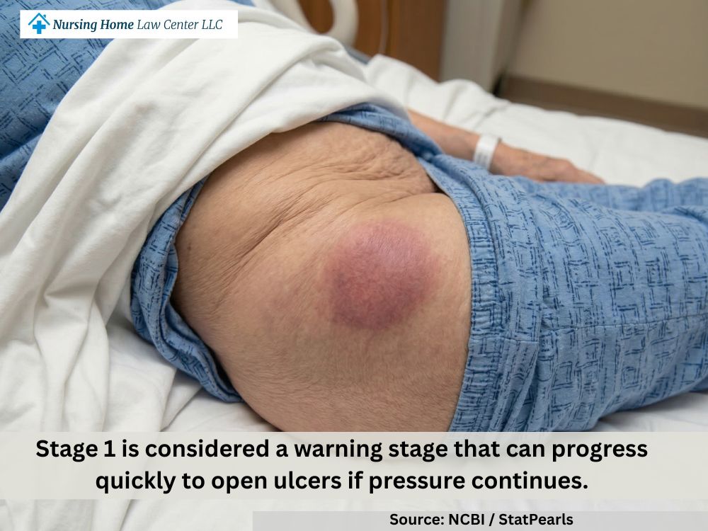 Stage 1 bed sore on intact skin with persistent discoloration (early pressure injury)