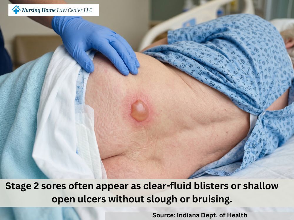 Stage 2 bed sore presenting as an intact or ruptured blister from pressure and shear

