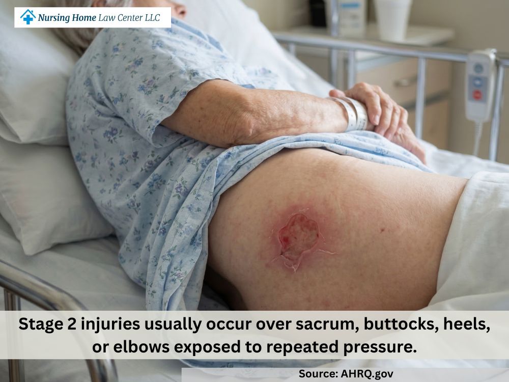 Stage 2 bed sore with partial-thickness skin loss and a shallow open ulcer
