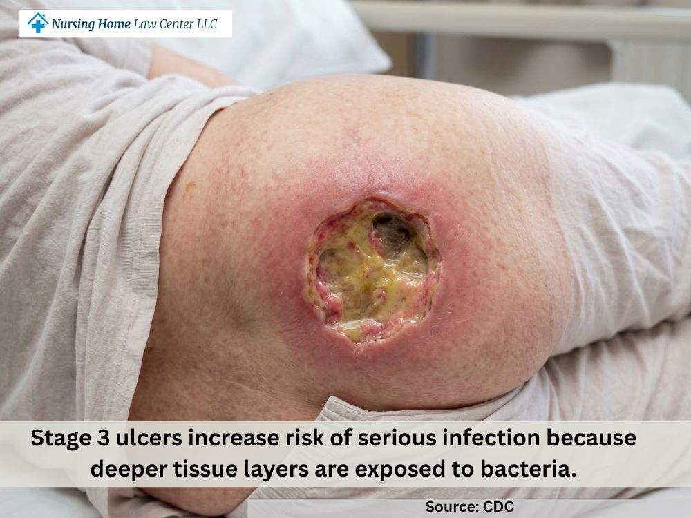 Stage 3 bed sore with full-thickness skin loss forming a deeper crater-like wound
