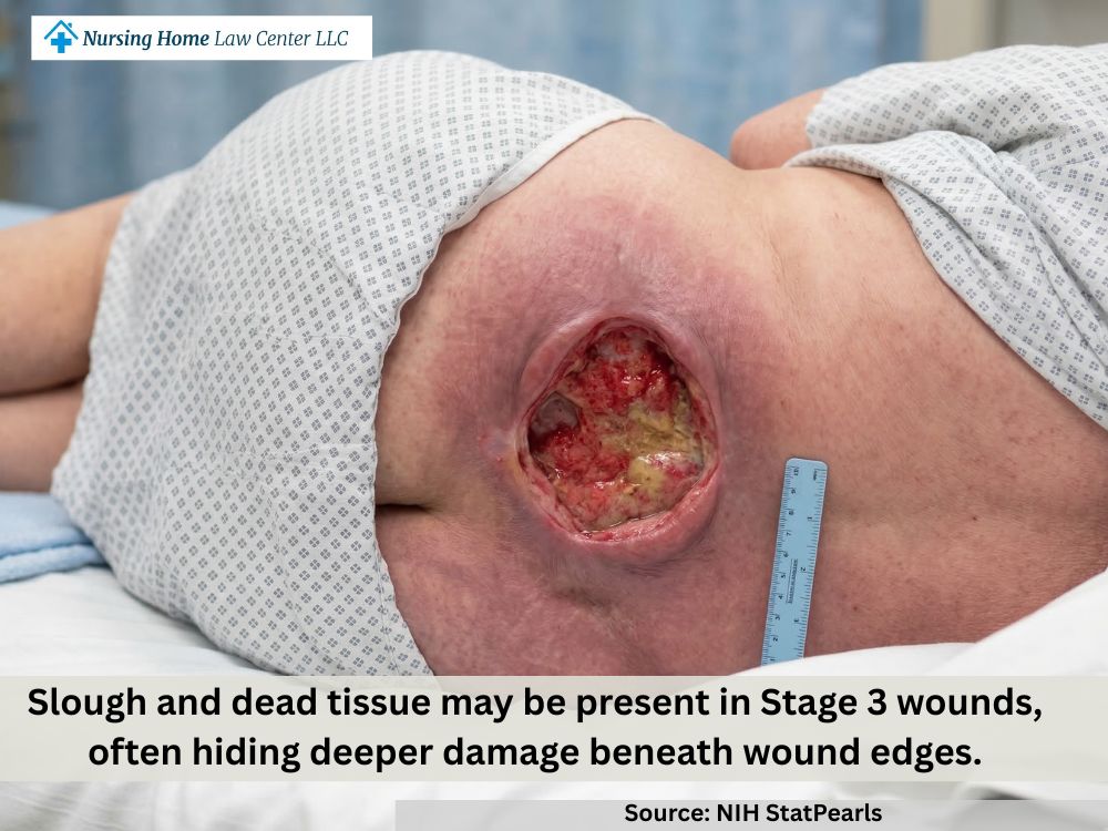 Stage 3 bed sore with undermining at the wound edges suggesting deeper tissue damage