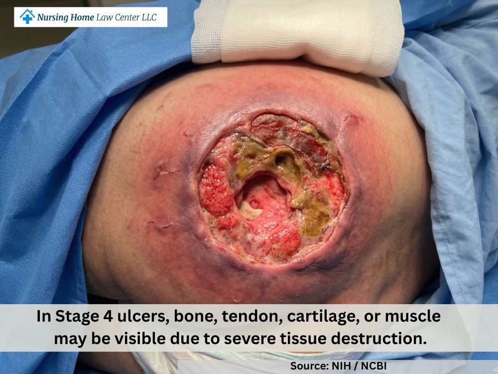 Stage 4 bed sore with extensive full-thickness tissue loss and very deep wound depth