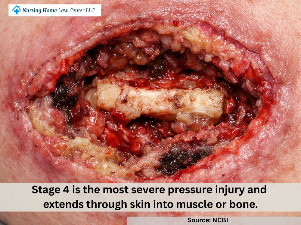 Stage 4 bed sore with full-thickness tissue loss and exposed bone in the wound bed

