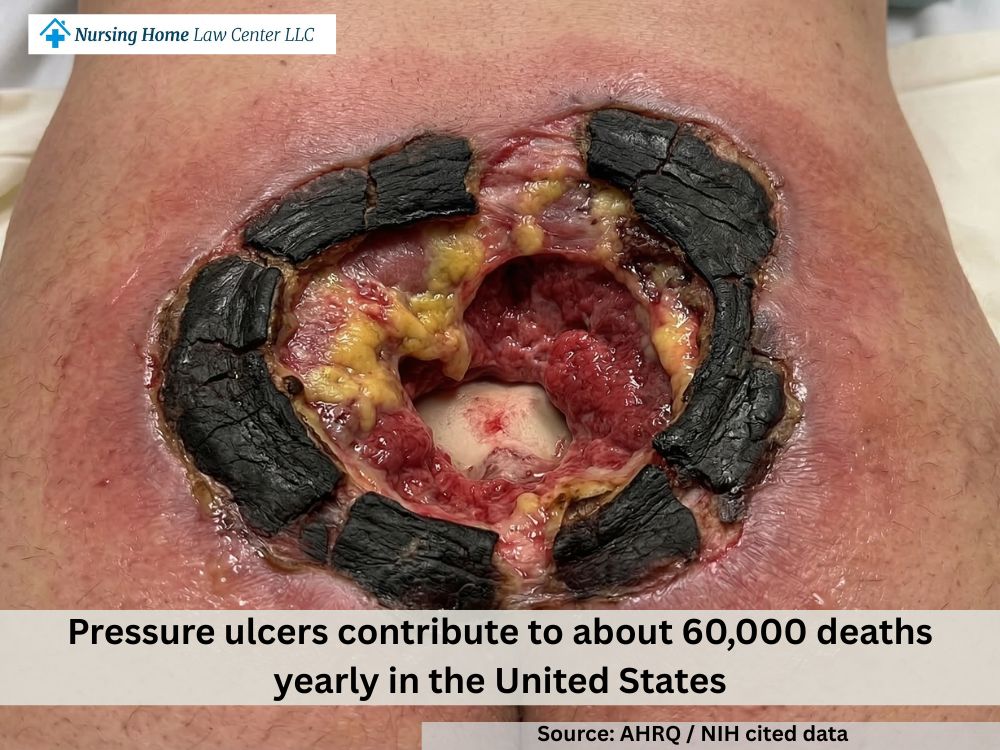 Stage 4 bed sore with undermining and tunneling beneath the surrounding skin