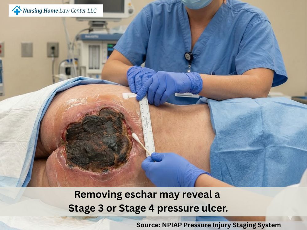 Unstageable pressure ulcer with black or brown eschar obscuring the extent of tissue loss