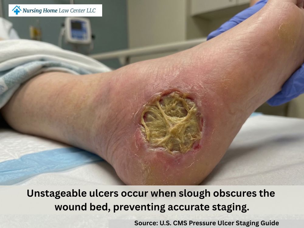 Unstageable pressure ulcer with yellow slough covering the wound bed so depth cannot be confirmed