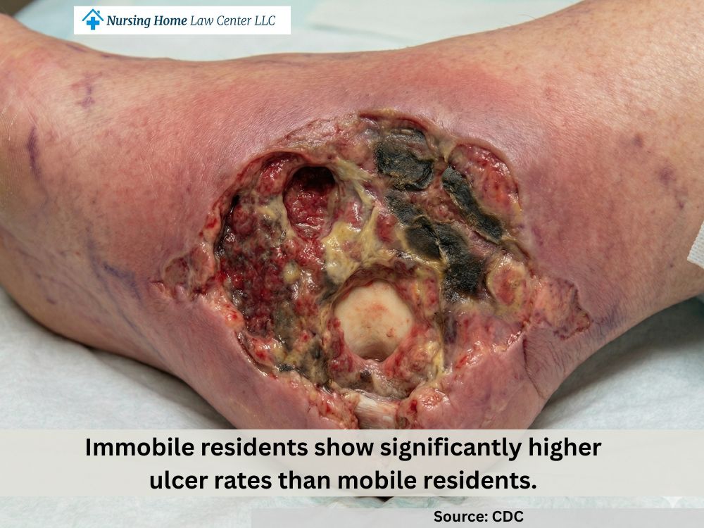 Nursing home abuse case involving a Stage 4 pressure ulcer and delayed care
